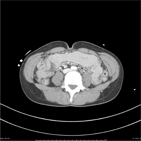 File:Traumatic renal artery dissection and pancreatic transection (Radiopaedia 37061-38739 Axial 207).jpg