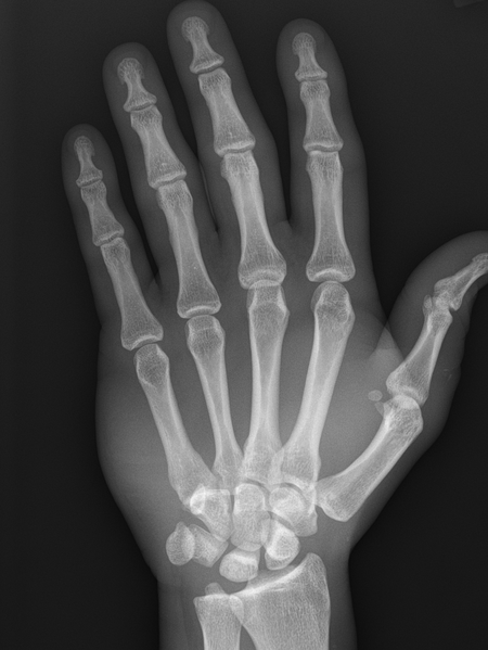 File:4th and 5th carpometacarpal joint dislocations (Radiopaedia 62934-71328 A 1).png
