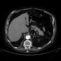 Abdominal aortic aneurysm (Radiopaedia 25855-26001 Axial C+ arterial phase 36).jpg