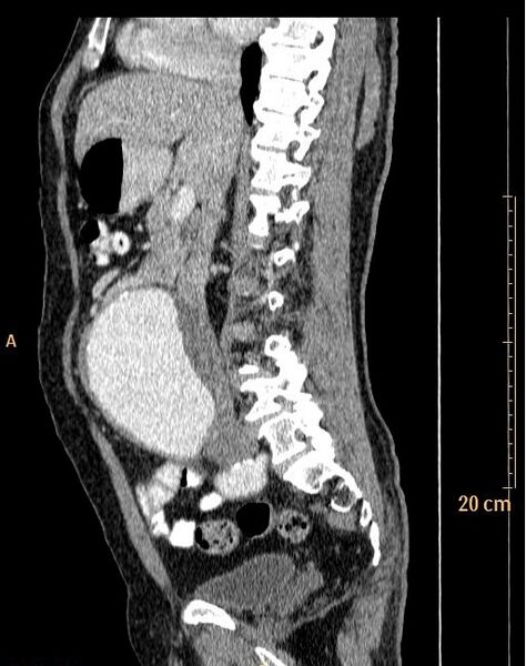 File:Abdominal aortic aneurysm (Radiopaedia 25985-26121 Sagittal C+ arterial phase 24).jpg