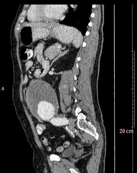 File:Abdominal aortic aneurysm (Radiopaedia 25985-26121 Sagittal C+ arterial phase 5).jpg