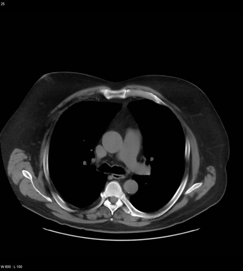 Abdominal aortic aneurysm with intramural hematoma then rupture (Radiopaedia 50278-55631 Axial non-contrast 21).jpg