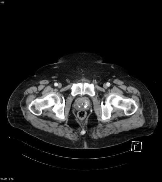 File:Abdominal aortic aneurysm with intramural hematoma then rupture (Radiopaedia 50278-55632 Axial C+ arterial phase 167).jpg