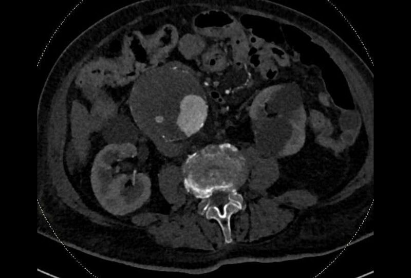 File:Abdominal aortic aneurysm with thrombus fissuration (Radiopaedia 73192-83919 Axial C+ arterial phase 103).jpg