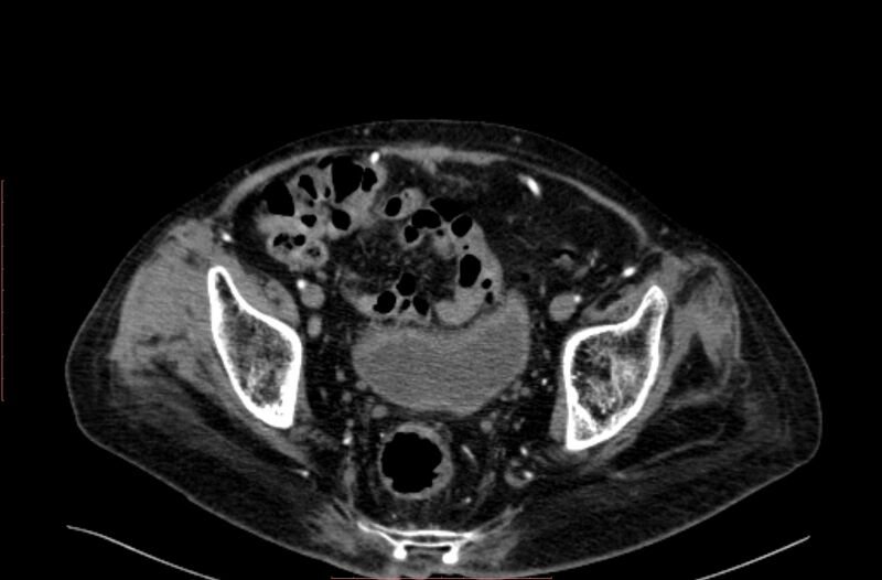 File:Abdominal aortic interposition tube graft and aneurysm thrombosis (Radiopaedia 71438-81857 Axial C+ arterial phase 205).jpg