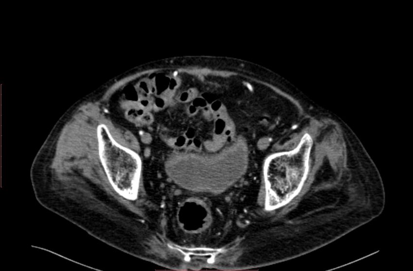 Abdominal aortic interposition tube graft and aneurysm thrombosis (Radiopaedia 71438-81857 Axial C+ arterial phase 205).jpg
