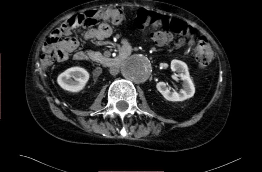 Abdominal aortic interposition tube graft and aneurysm thrombosis (Radiopaedia 71438-81857 Axial C+ arterial phase 68).jpg