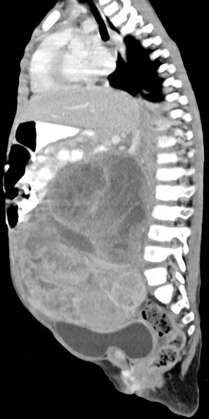 File:Abdominopelvic rhabdomyosarcoma (Radiopaedia 78356-90984 Sagittal C+ portal venous phase 49).jpg