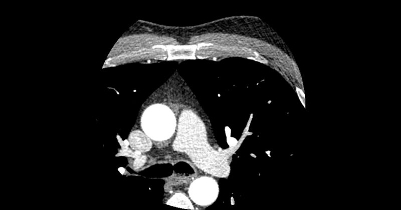 File:Aberrant left main coronary artery (ALMCA) arising from the right sinus with interarterial course (Radiopaedia 63251-71814 Axial C+ arterial phase 6).JPG