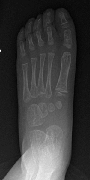File:Absent navicular with background Kabuki syndrome (Radiopaedia 56133-62785 AP 1).png
