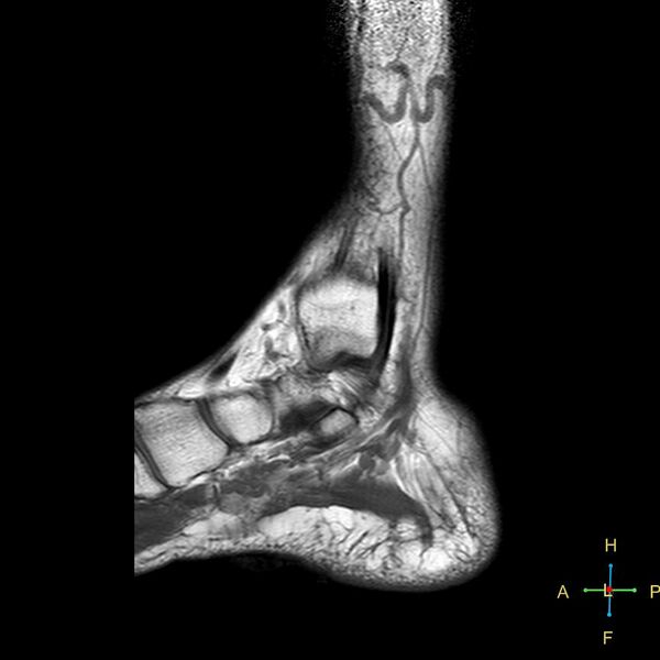 File:Achilles tendon complete tear (Radiopaedia 22834-22854 Sagittal T1 14).jpg