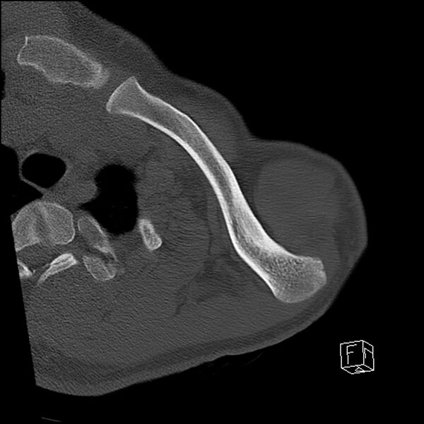 File:Acromioclavicular joint dissociation - type IV (Radiopaedia 64411-73216 Axial bone window 7).jpg