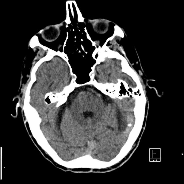 File:Acute ICA ischemic penumbra due to high-grade CCA stenosis (CT perfusion) (Radiopaedia 72038-82529 Axial non-contrast 13).jpg