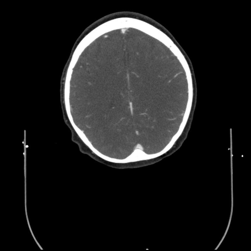 Acute M1 occlusion with ischemic penumbra (CT perfusion) (Radiopaedia 71897-82344 Axial C+ arterial phase thins 10).jpg