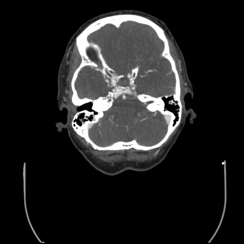 Acute M1 occlusion with ischemic penumbra (CT perfusion) (Radiopaedia 71897-82344 Axial C+ arterial phase thins 113).jpg