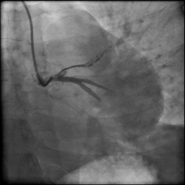 File:Acute anteroseptal myocardial infarction (Radiopaedia 68409-77946 LAO caudal (spider view) LAD and CX 15).jpg