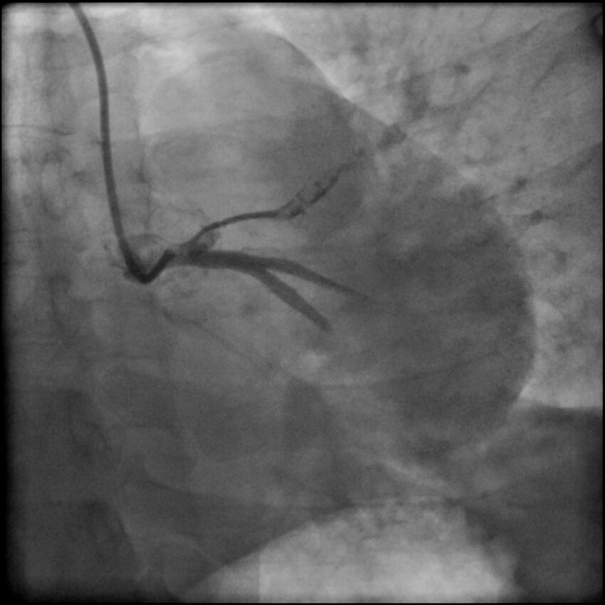Acute anteroseptal myocardial infarction (Radiopaedia 68409-77946 LAO caudal (spider view) LAD and CX 15).jpg