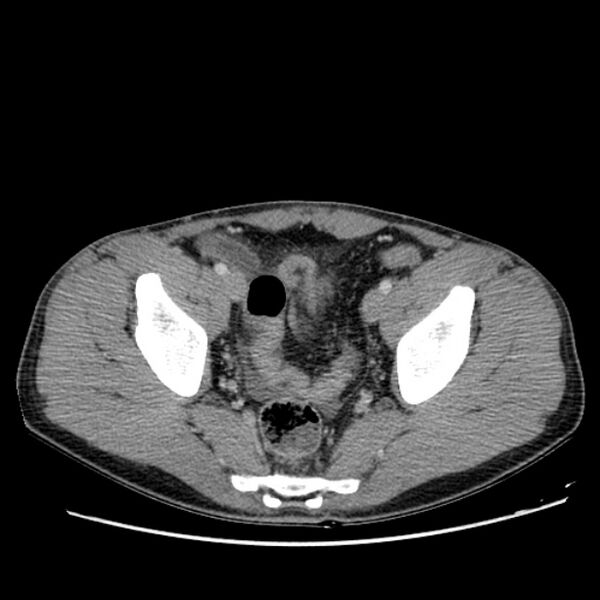 File:Acute appendicitis (Radiopaedia 27049-27227 Axial C+ portal venous phase 65).jpg