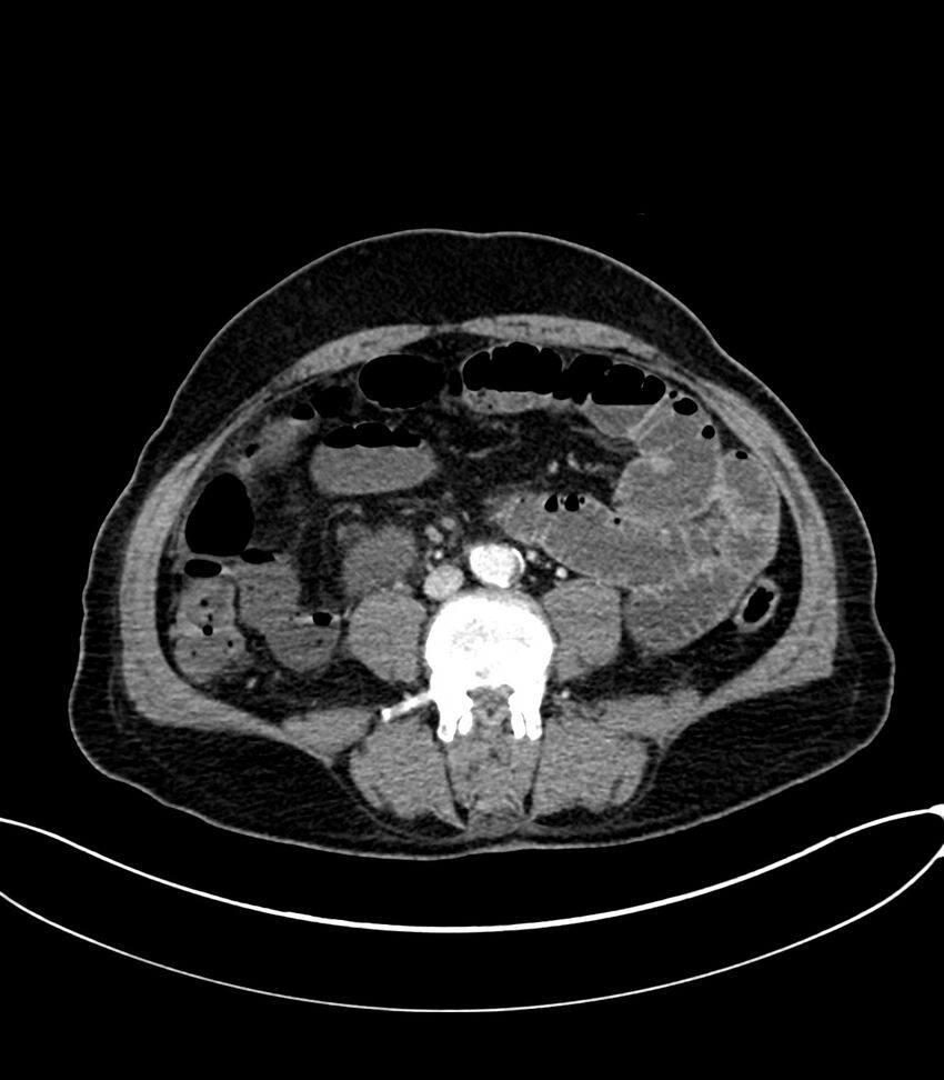 Acute arterial mesenteric ischemia (Radiopaedia 78238-90828 Axial C+ portal venous phase 81).jpg