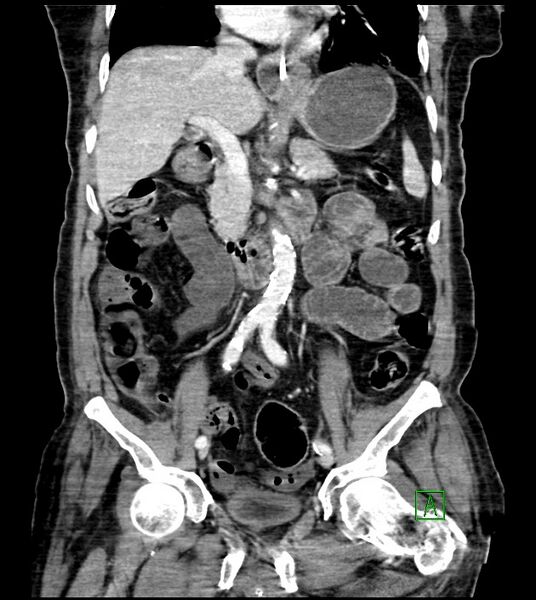 File:Acute arterial mesenteric ischemia (Radiopaedia 78238-90828 Coronal C+ portal venous phase 49).jpg