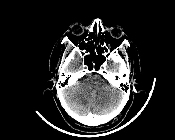 File:Acute cerebral infarct (Radiopaedia 35604-37123 Axial non-contrast 23).jpg