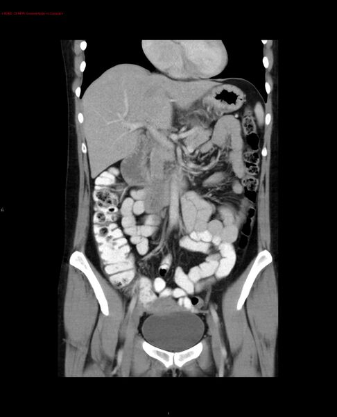 File:Acute gastritis (Radiopaedia 21043-20975 Coronal C+ portal venous phase 16).jpg