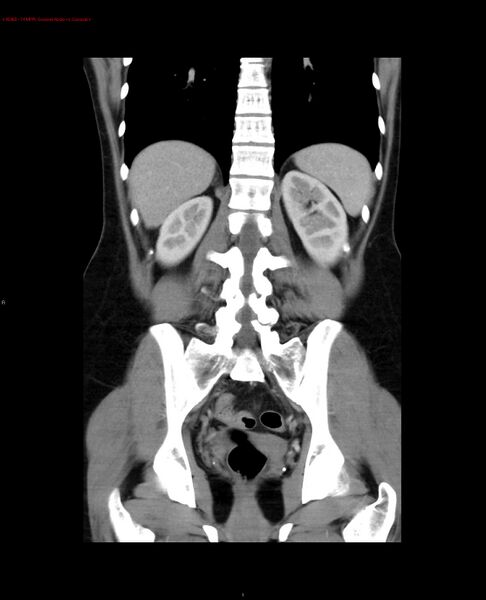 File:Acute gastritis (Radiopaedia 21043-20975 Coronal C+ portal venous phase 4).jpg
