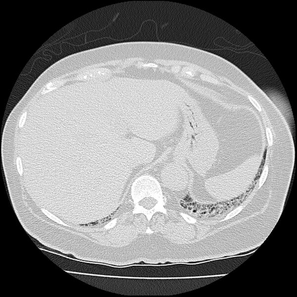 File:Acute interstitial pneumonitis (Radiopaedia 45404-49452 Axial lung window 83).jpg