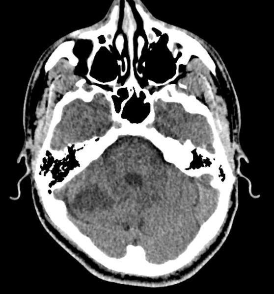 File:Acute ischemic stroke - posterior circulation territory (Radiopaedia 77670-89881 non-contrast 23).jpg
