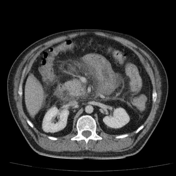 File:Acute pancreatitis (Radiopaedia 26663-26813 Axial C+ portal venous phase 33).jpg