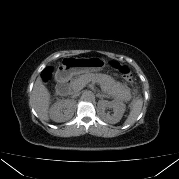 File:Acute pancreatitis - Balthazar C (Radiopaedia 26569-26714 Axial non-contrast 33).jpg