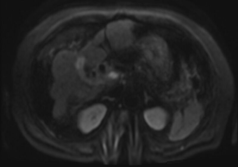 File:Acute portal vein thrombosis (Radiopaedia 73198-83925 Axial DWI 45).jpg
