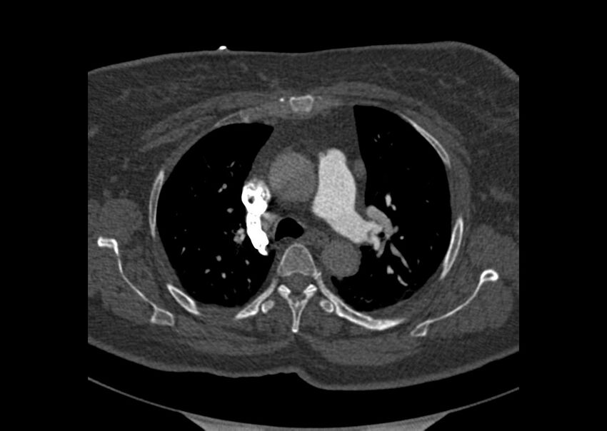 Acute pulmonary embolism (Radiopaedia 29938-30466 Axial C+ CTPA 24).jpg