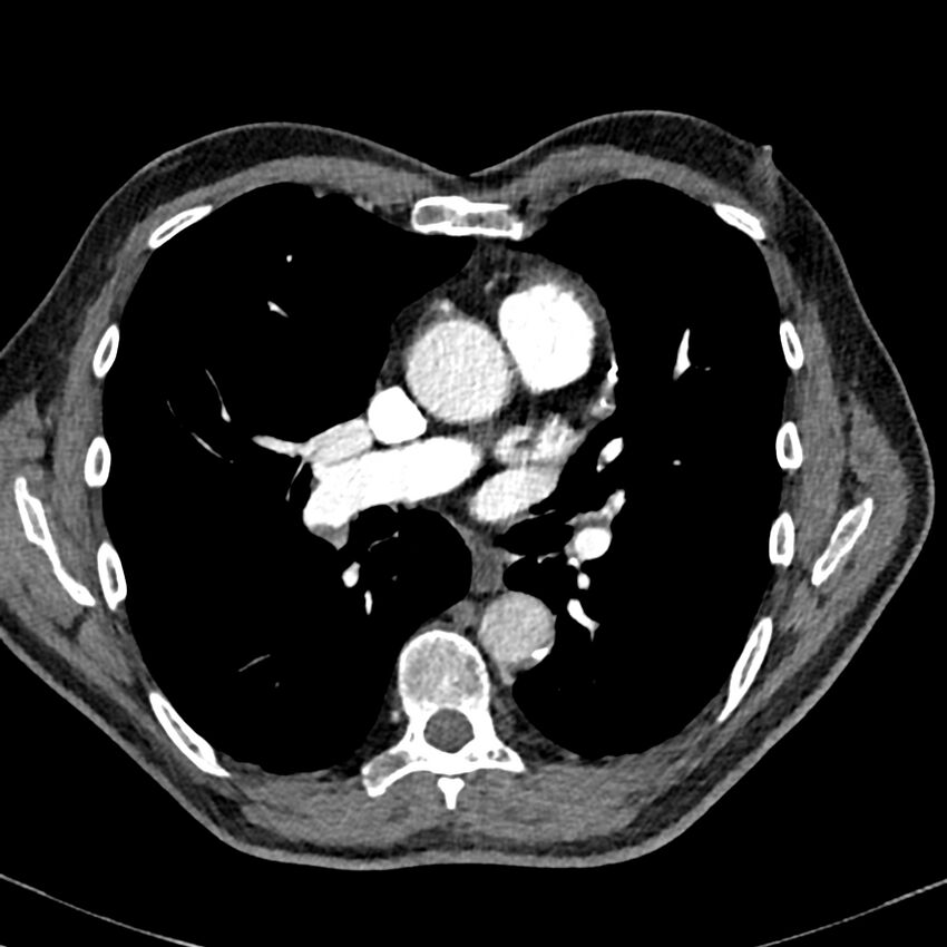 Acute pulmonary embolism (Radiopaedia 81677-95570 Axial C+ CTPA 47).jpg