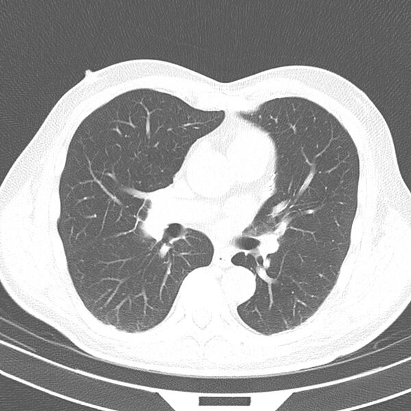 File:Acute pulmonary embolism (Radiopaedia 81677-95570 Axial lung window 23).jpg