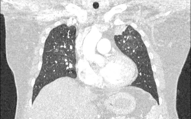 File:Acute pulmonary embolism with pulmonary infarcts (Radiopaedia 77688-89908 Coronal lung window 32).jpg