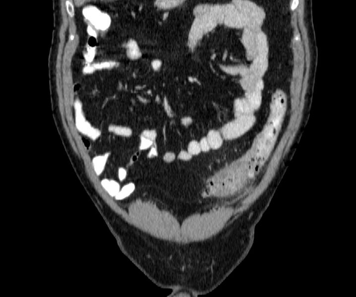 File:Acute sigmoid colon diverticulitis (Radiopaedia 55507-61976 Coronal C+ portal venous phase 25).jpg