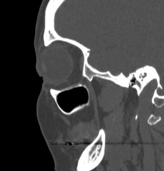 File:Acute sinusitis (Radiopaedia 22419-22455 Sagittal non-contrast 4).jpg