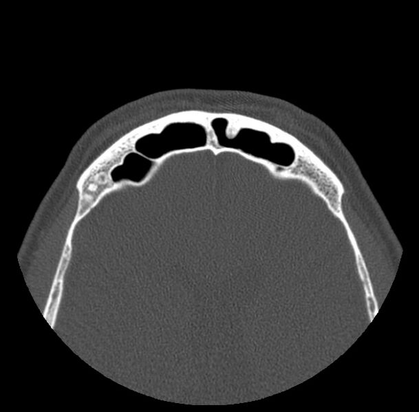 File:Acute sinusitis (Radiopaedia 23161-23215 Axial bone window 69).jpg