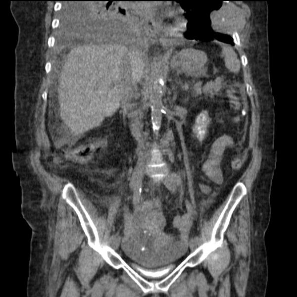 File:Acute tubular necrosis (Radiopaedia 28077-28334 D 47).jpg
