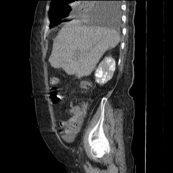 File:Acute tubular necrosis (Radiopaedia 28077-28334 Sagittal non-contrast 26).jpg