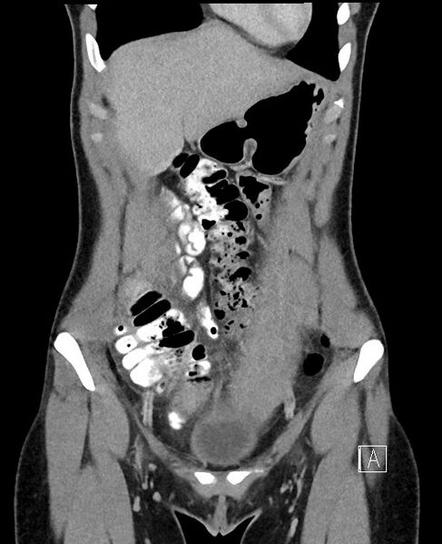 File:Acute uncomplicated appendicitis (Radiopaedia 61374-69304 Coronal C+ portal venous phase 23).jpg