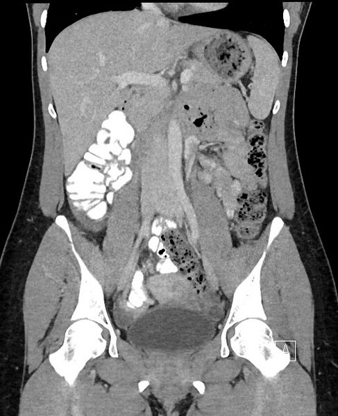 File:Acute uncomplicated appendicitis (Radiopaedia 61374-69304 Coronal C+ portal venous phase 49).jpg