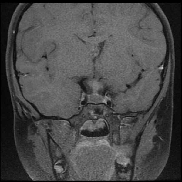 File:Adamantinomatous craniopharyngioma (Radiopaedia 77407-89529 Coronal T1 C+ fat sat 5).jpg