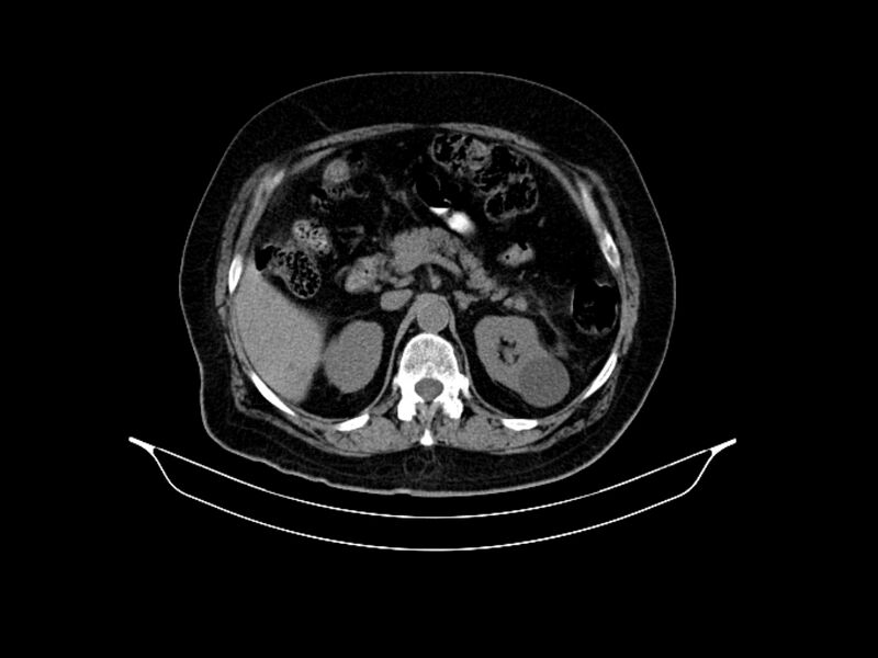 File:Adenocarcinoma of pancreas with hepatic metastasis (Radiopaedia 64332-73122 Axial non-contrast 36).jpg