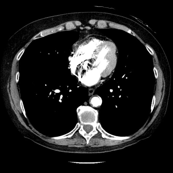 File:Adenocarcinoma of the lung (Radiopaedia 41015-43755 Axial C+ portal venous phase 80).jpg