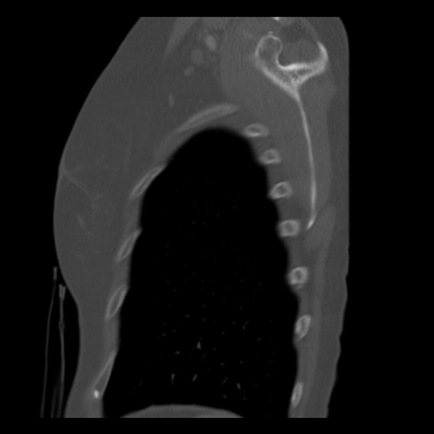 Adenocarcinoma of the lung (Radiopaedia 41015-43755 Sagittal bone window 99).jpg