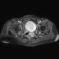 Adenomyoma of the uterus (huge) (Radiopaedia 9870-10438 Axial T1 C+ fat sat 10).jpg