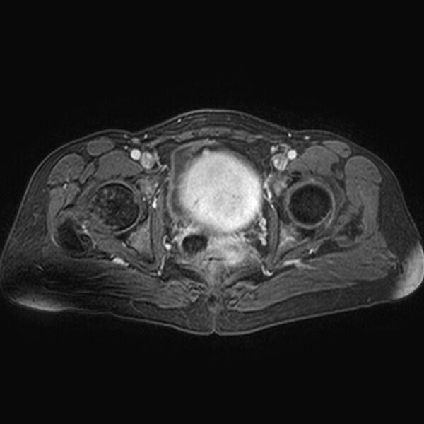 File:Adenomyoma of the uterus (huge) (Radiopaedia 9870-10438 Axial T1 C+ fat sat 10).jpg