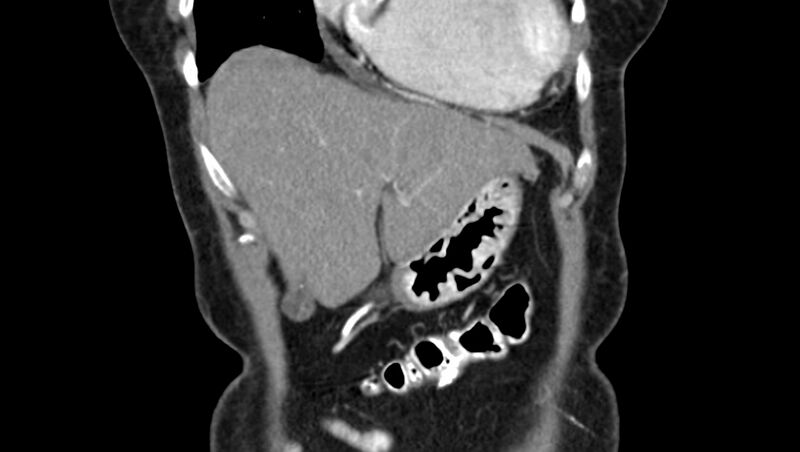 File:Adenomyomatosis of the gallbladder (Radiopaedia 12142-12483 Coronal C+ arterial phase 3).jpg